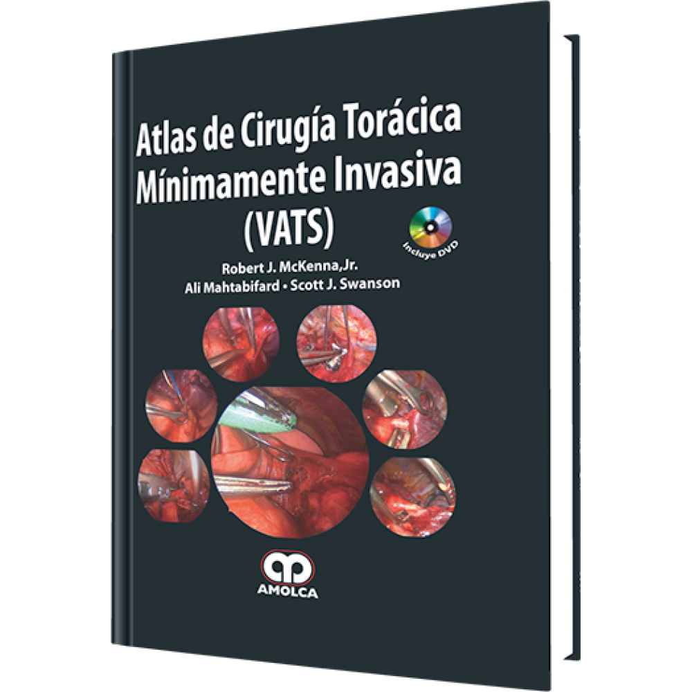 McKenna, Atlas de Cirugia Toracica Minimamente Invasiva (VATS)