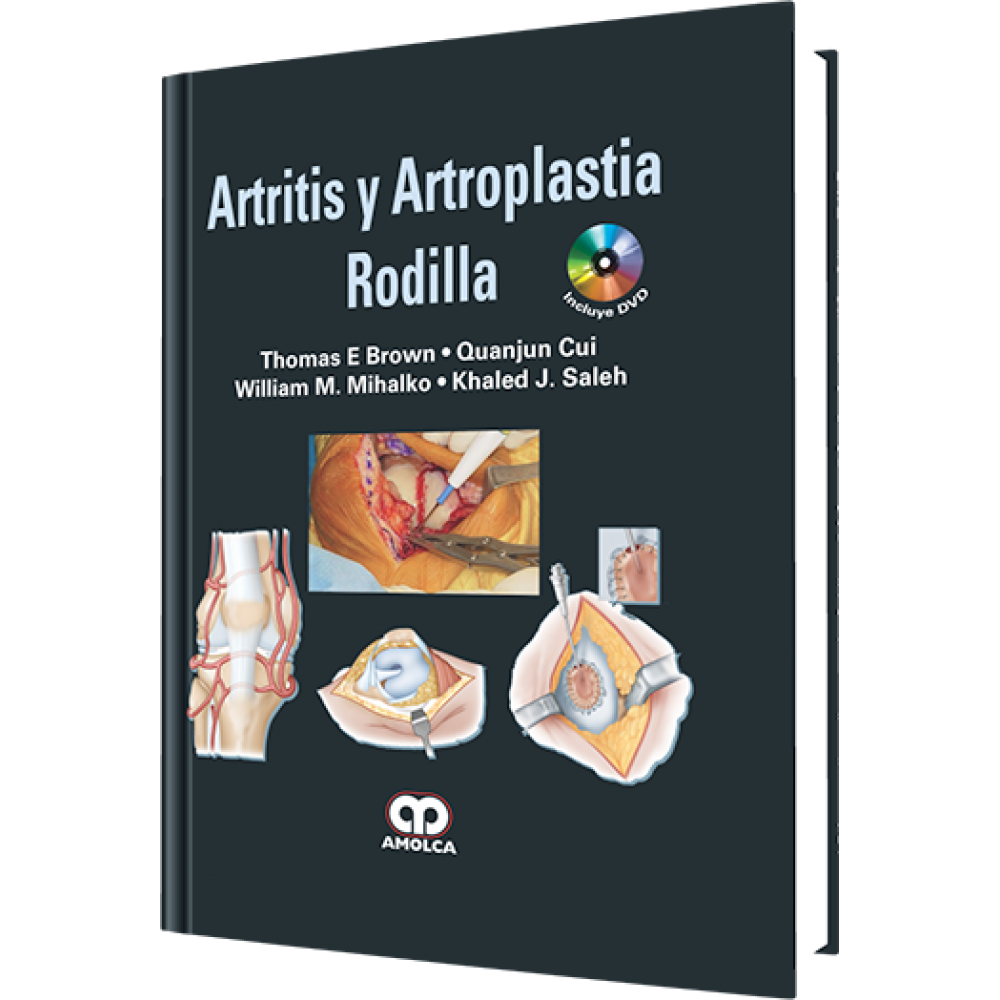 Brown, Artritis y Artroplastia – Rodilla