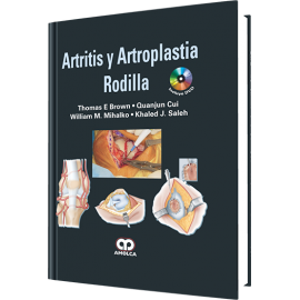 Brown, Artritis y Artroplastia – Rodilla
