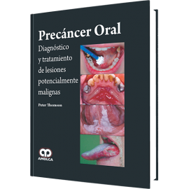 Thomson - Precancer Oral / Diagnostico y tratamiento de lesiones potencialmente malignas - Peter