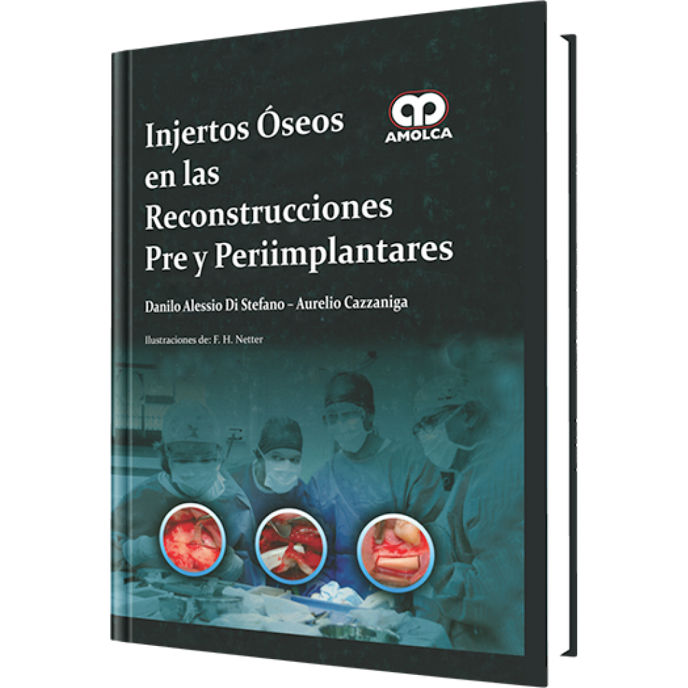 Injertos Oseos en las Reconstrucciones Pre y Periimplantares - Danilo Alessio Di Stefano