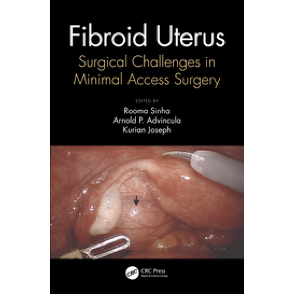 Fibroid Uterus Surgical Challenges in Minimal Access Surgery